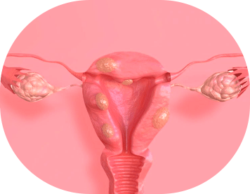 Mioma uterino